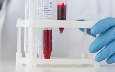 Could Placental Growth Factor Testing Transform Preeclampsia Care in Canada and Beyond?